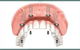 Denture Success - thumb 2