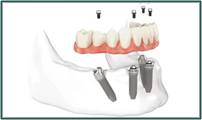 Denture Success - Suburb Australia 4