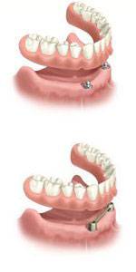 Precise Dentures – Blair Grundy Denture Clinic - Suburb Australia 2